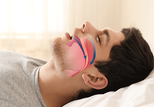 snoring man in need of sleep apnea treatment